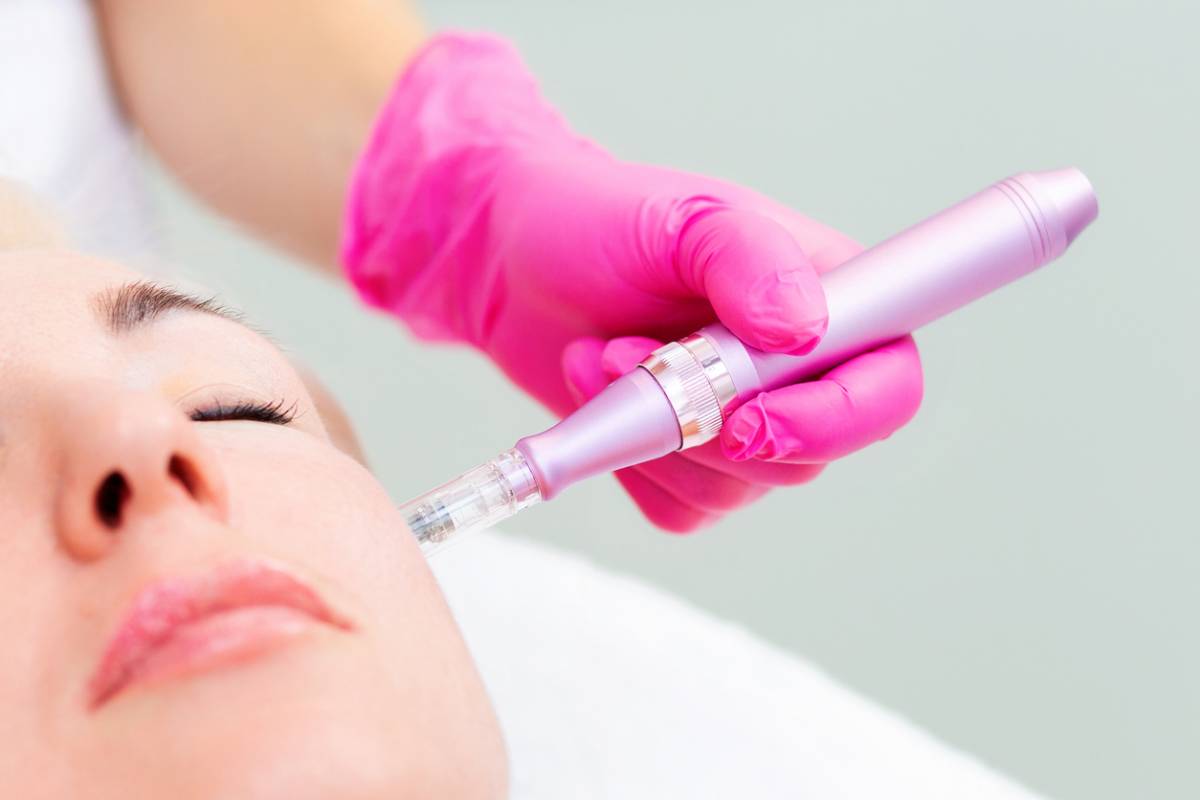 tout-savoir-sur-le-microneedling-