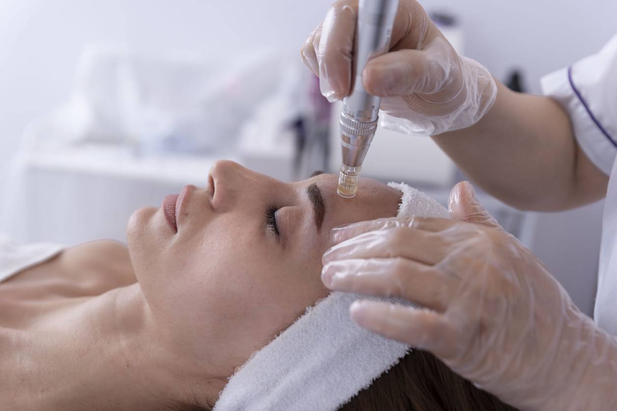 tout-savoir-sur-le-microneedling-